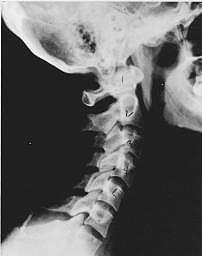 subluxation_near_normal