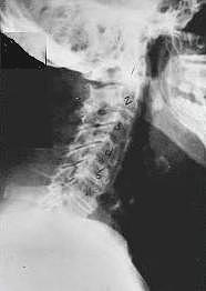 subluxation_phase_four