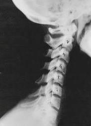 subluxation_phase_one