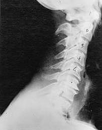 subluxation_phase_three