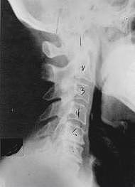 subluxation_phase_two