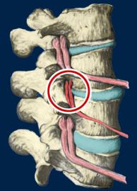 subluxation_still